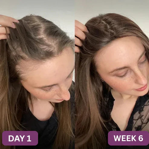 VitalHeal® Hair Growth Accelerator Gummies